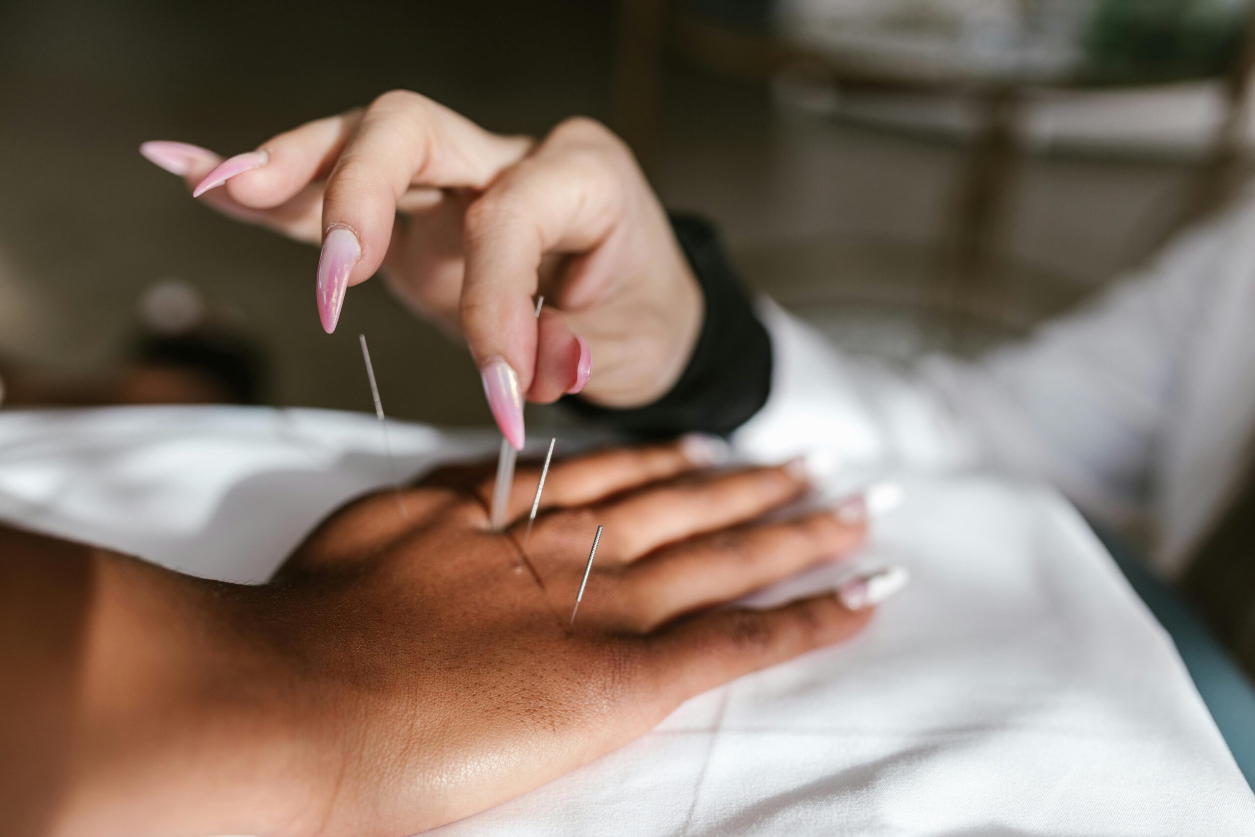 Acupunctuur-fysiotherapie